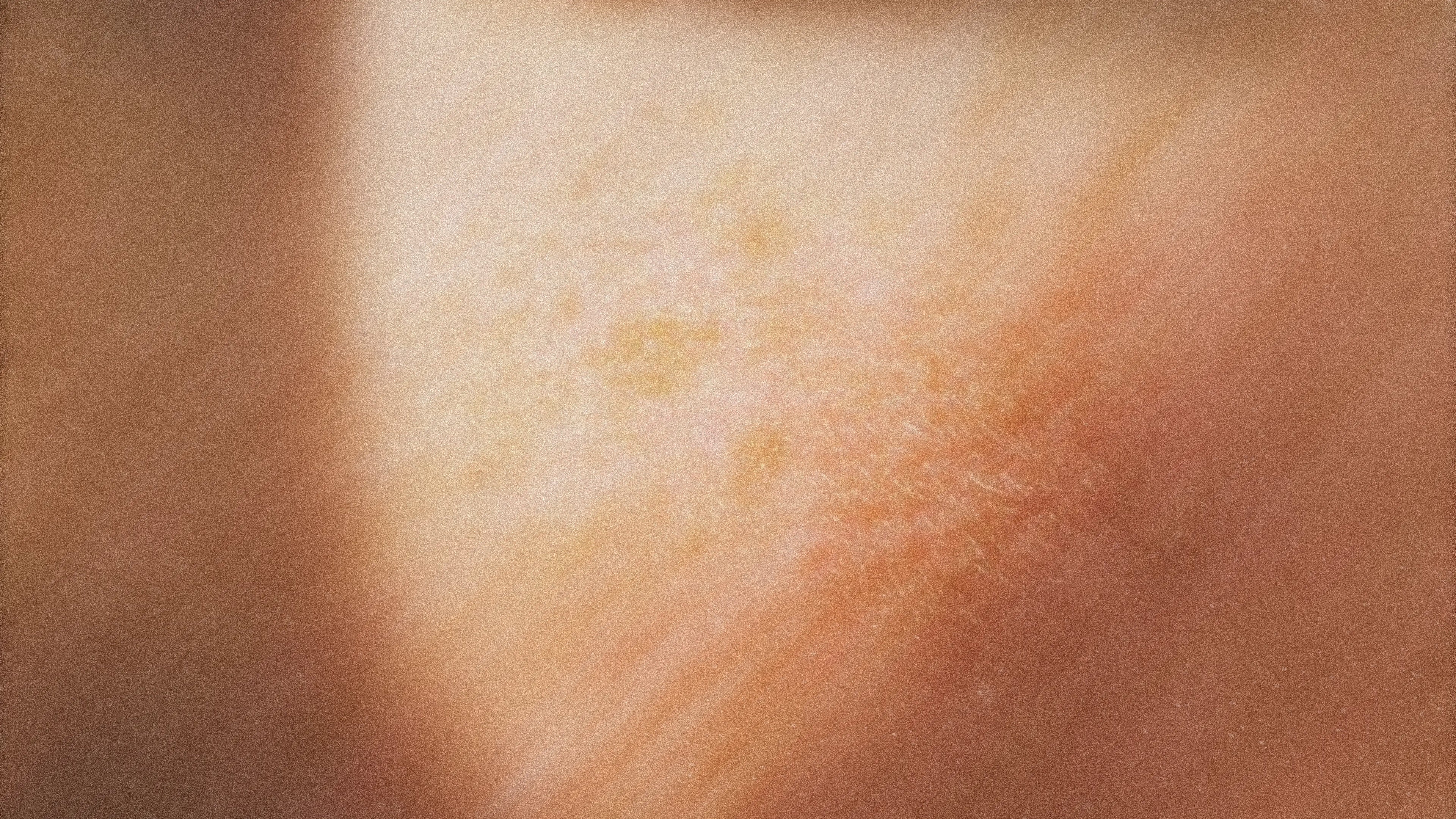 The Anatomy of a Pore: How Solid Oils Help Prevent Comedogenic Blockages